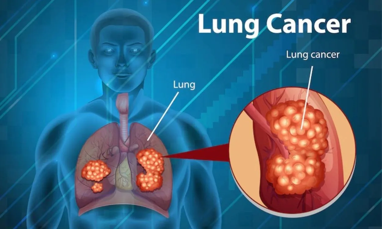 Lung cancer symptoms