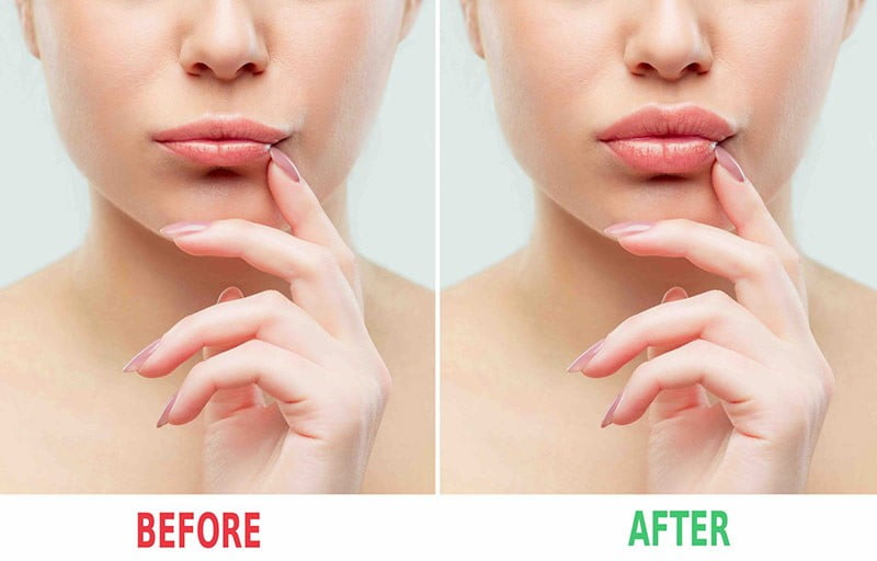 lip plastic surgery in Gurugram